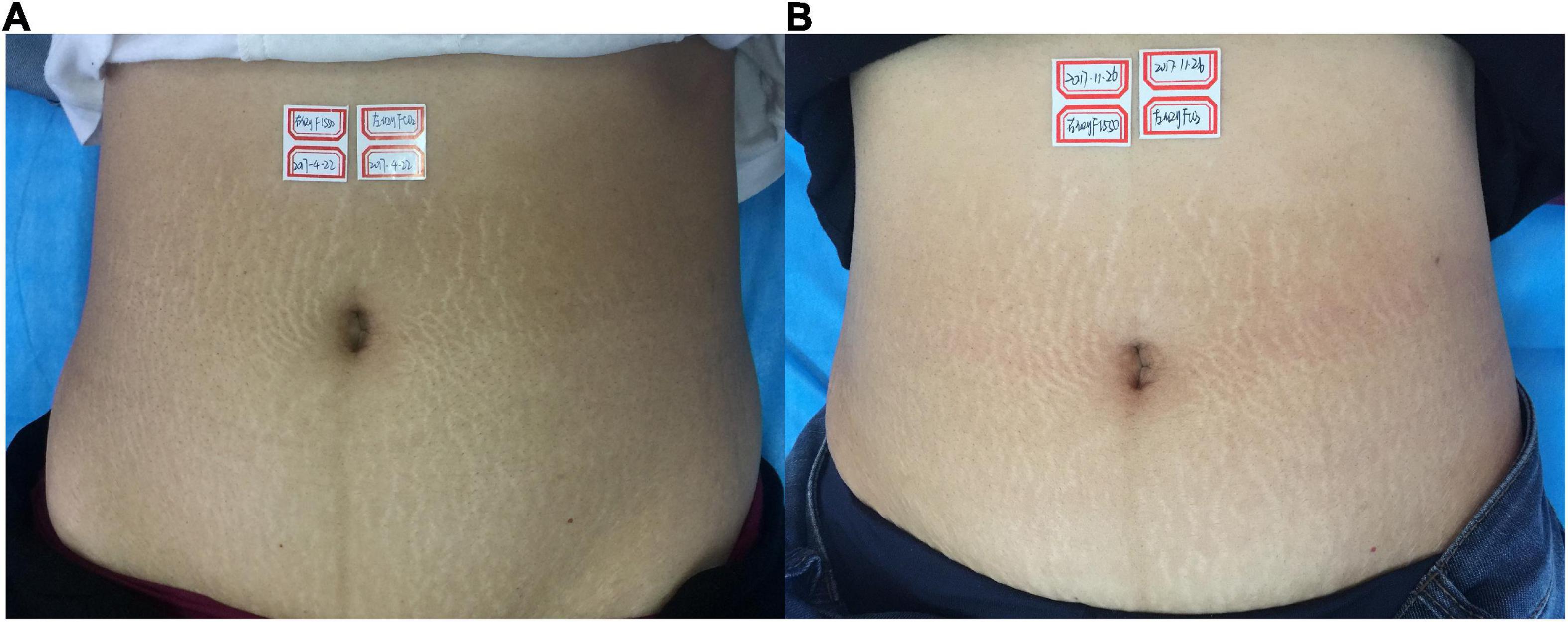 Treatment of striae albae with 1,550 nm Er: Glass vs. CO2 fractional laser: A self-controlled study